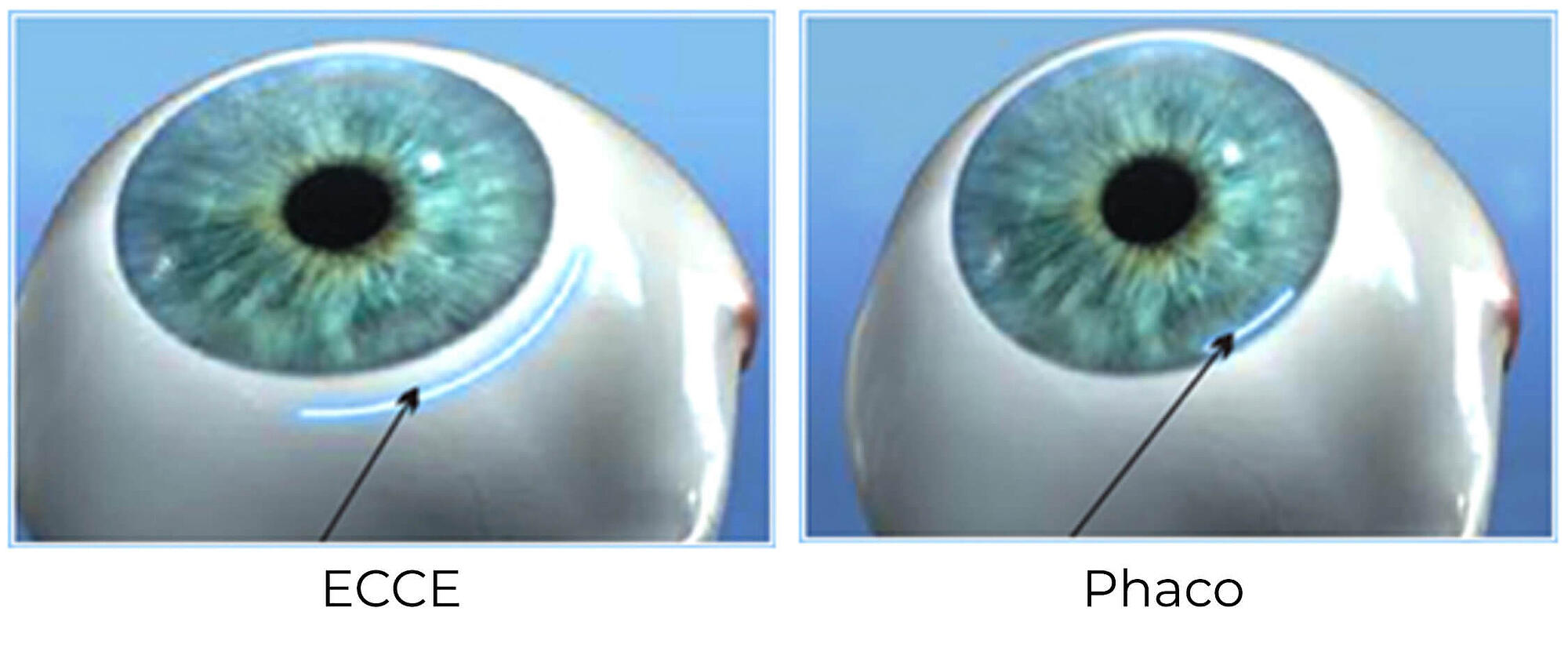 Phaco procedure