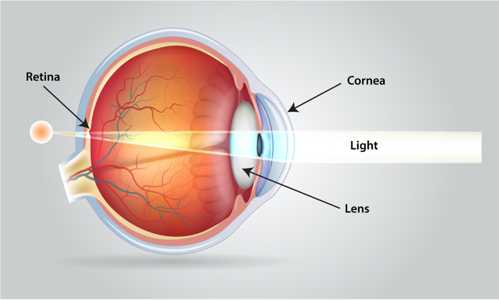 Hipermetropia diagram
